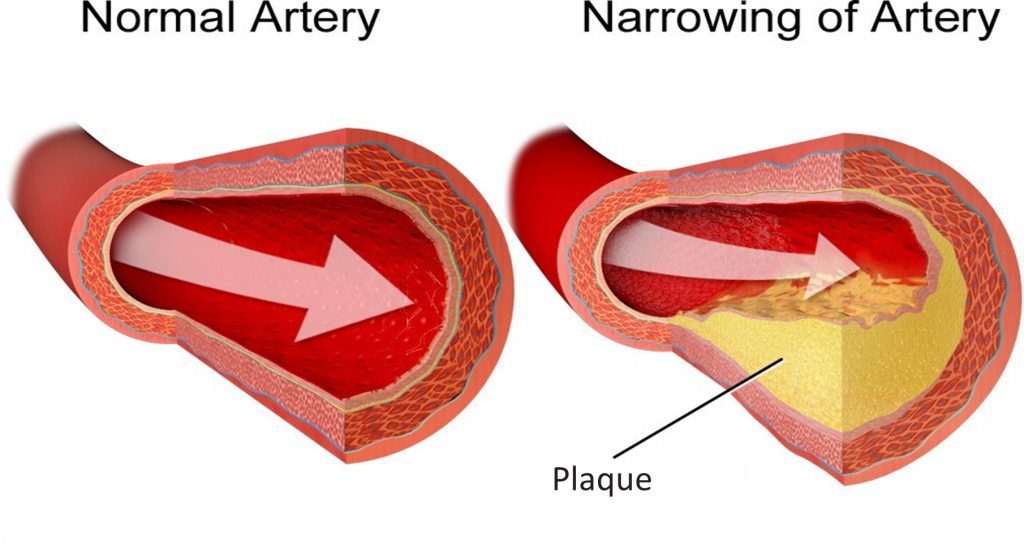 Narrowing artery