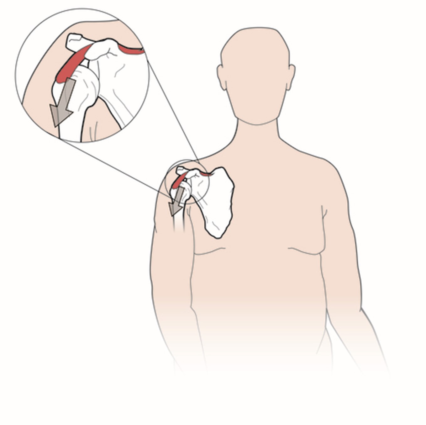 Shoulder Pain Guide for Stroke Recovery
